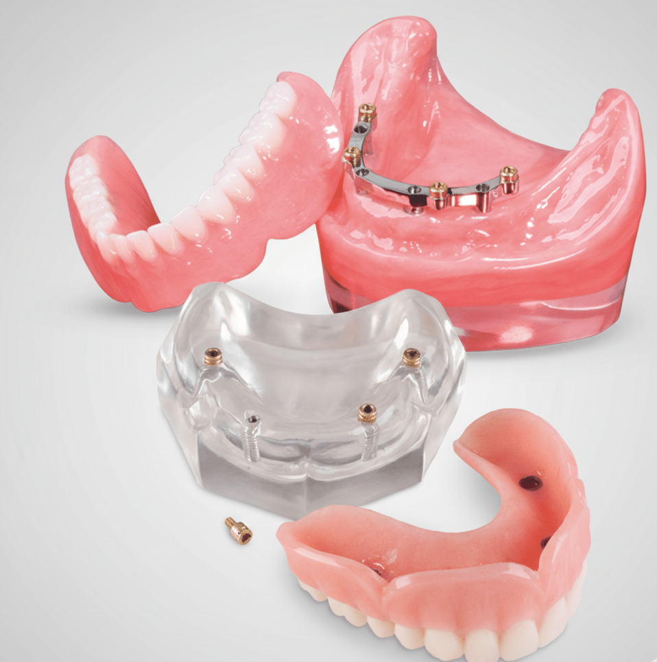 Implant Overdentures